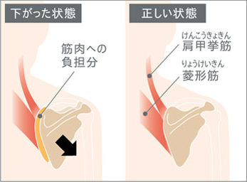 肩甲骨の下がった状態と正しい状態